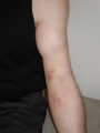 Réparation Endoscopique des ruptures distales du biceps brachial
