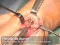 Rhizarthrose - Prothèse Trapézo-métacarpienne