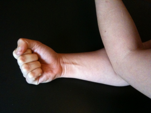 Traitement endoscopique du syndrome de loge à l'avant-bras (arm pump du motard)